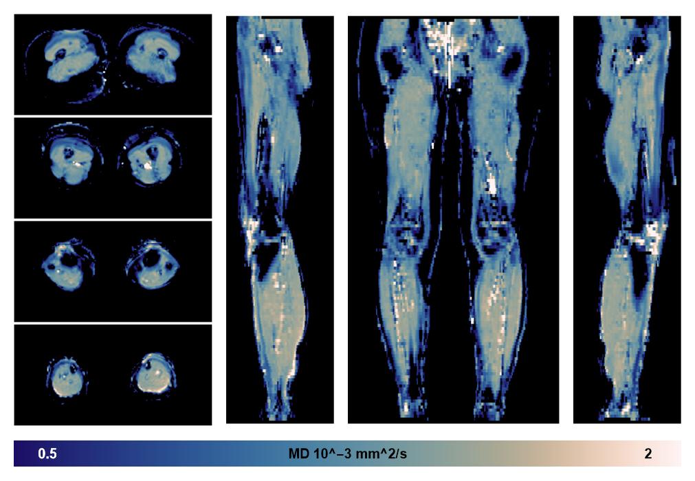 IVIM corrected whole leg muscle mean diffusivity obtained from diffusion tensor imaging.